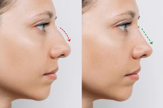Rinoplastie în România vs Turcia